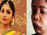 Pictures of Kannada actress Swathi Sathish go viral after her root canal surgery goes wrong